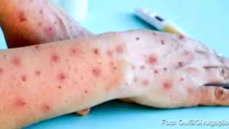 Governador Valadares descarta dois casos suspeitos de MPOX após exames negativos