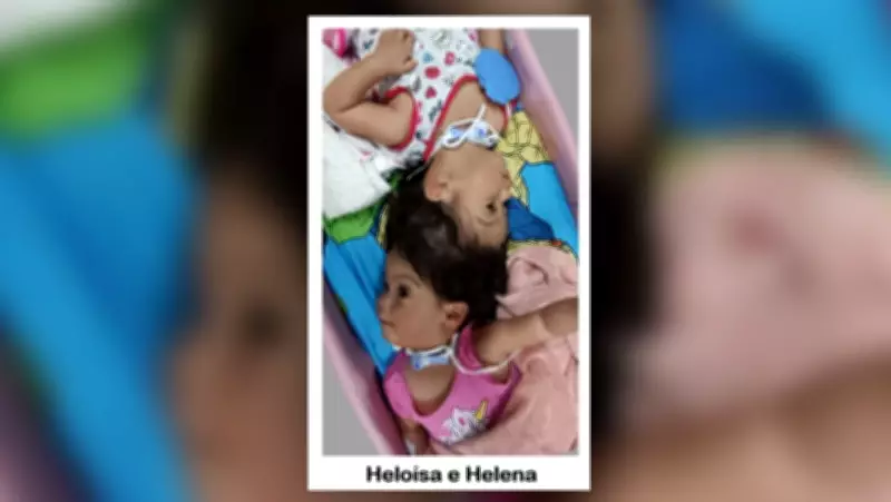Mãe de gêmeas siamesas sonha em carregar filhas no colo após cirurgias de separação