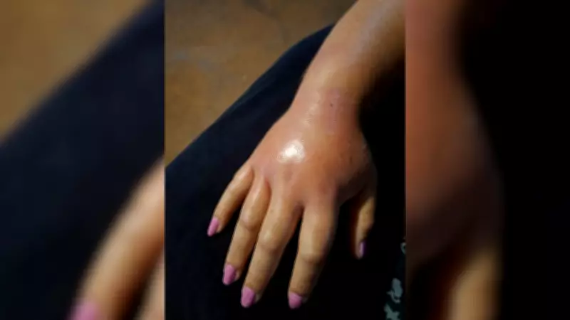 Mulher picada por jararaca em Pontalinda (SP) relata dor insuportável e medo de morte