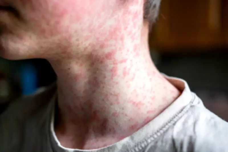 Surto de sarampo na Bolívia preocupa Brasil após caso confirmado em bebê de São Paulo