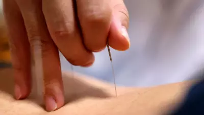 Acupuntura ganha força no Brasil com nova lei e integração no tratamento da dor