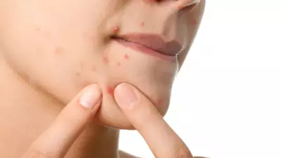 Alimentos que prejudicam a pele: dermatologistas alertam sobre inflamações e acne