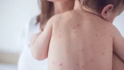 Bebê de seis meses é primeiro caso de sarampo em São Paulo em 2026