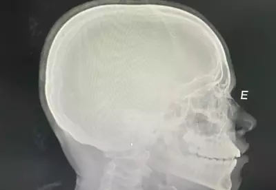 Estudante sofre fratura no nariz após agressão racista em escola de Dianópolis