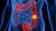 Câncer colorretal: casos aumentam entre jovens e prevenção é fundamental
