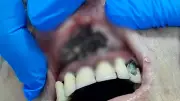 Idosa com infecção grave de larvas na boca é resgatada de clínica clandestina em Ribeirão Preto
