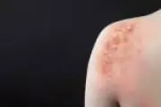 Mpox continua circulando no Brasil com 140 casos confirmados em 2026