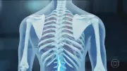 Três pacientes realizam procedimento experimental com polilaminina em Campo Grande após decisões judiciais