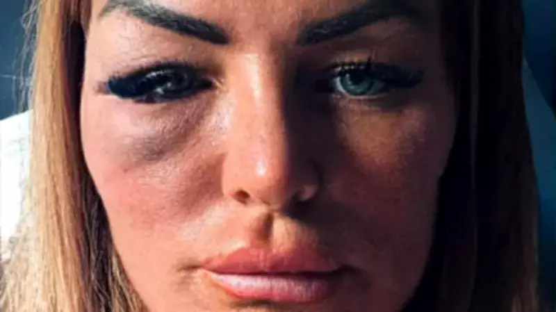 Esteticista tem vida devastada por soco de lutador de MMA após rejeitar avanços em bar