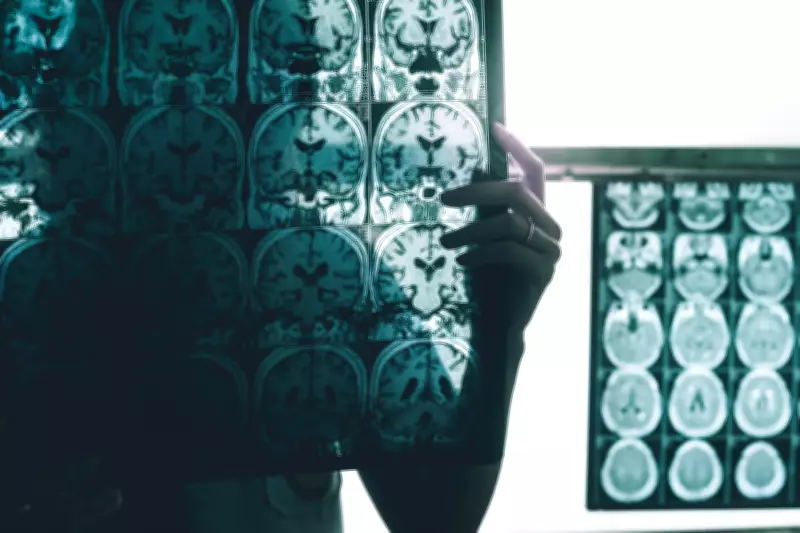 Estudo revela que Alzheimer segue 'mapa' do cérebro ao se espalhar por conexões neurais