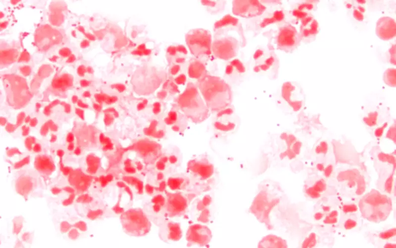 Itapetininga e Tatuí registram casos de meningite em 2025; saiba sintomas e prevenção