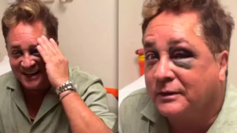 Leonardo sofre acidente durante pescaria no Pantanal e fica com hematoma no olho