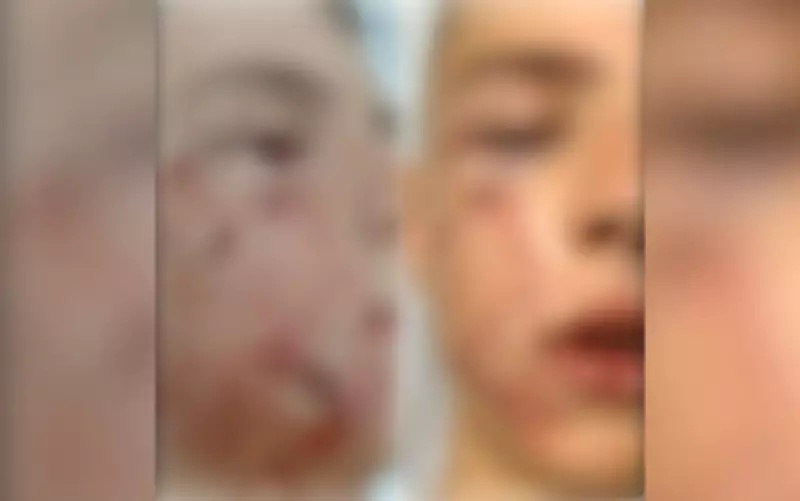 Menino de 10 anos sofre ataque de pit bull em Anápolis e passa por cirurgia plástica