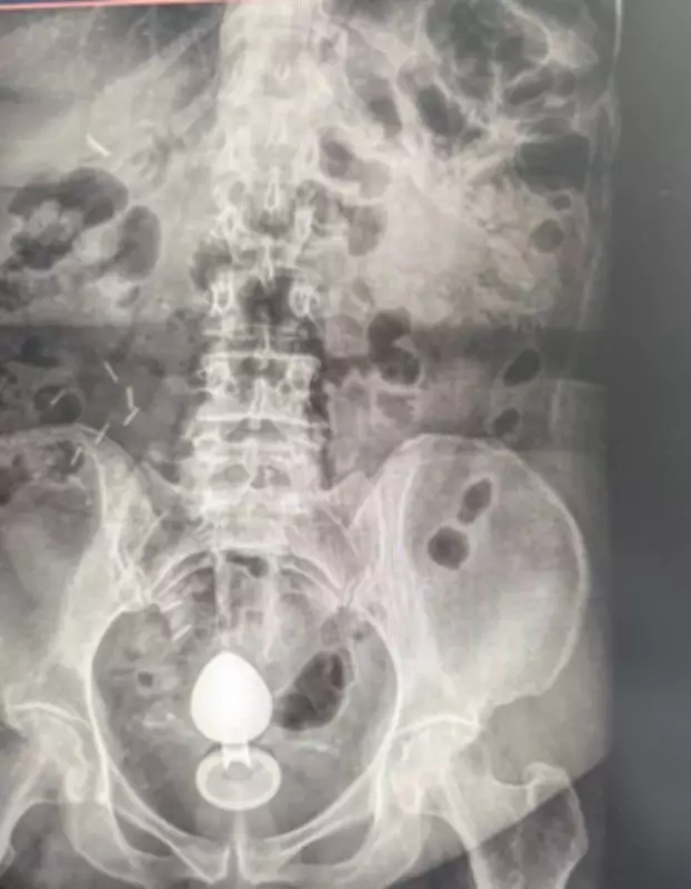 Mulher é internada após plug anal ficar preso no intestino; médicos alertam para riscos