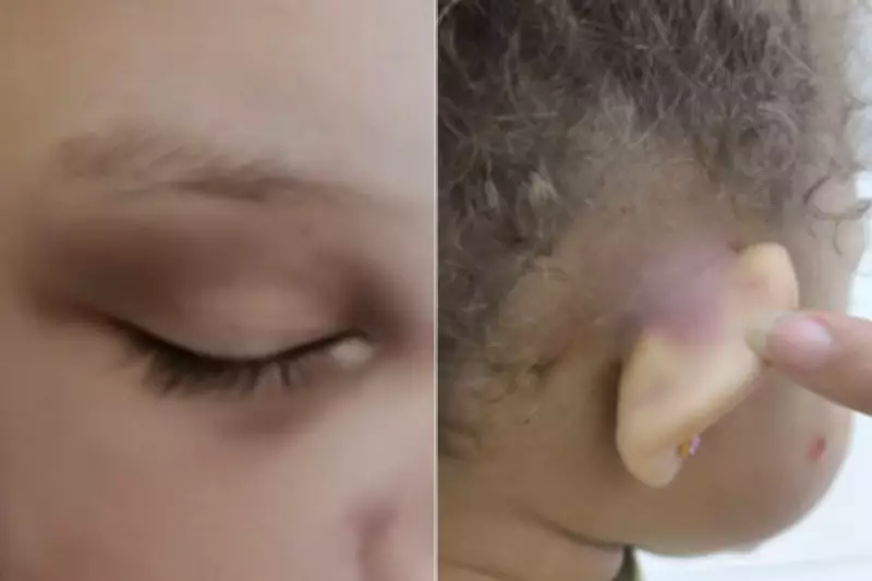 Pai encontra filha de 2 anos com hematomas após dia em creche municipal de Praia Grande