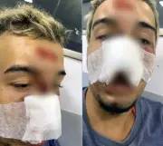 Ciclista perde sete dentes após cair em buraco em ciclovia sem iluminação em Japeri