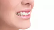 Dentes desalinhados podem causar dores de cabeça e problemas de saúde