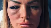 Esteticista tem vida devastada por soco de lutador de MMA após rejeitar avanços em bar