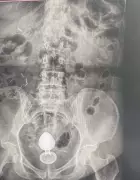 Mulher é internada após plug anal ficar preso no intestino; médicos alertam para riscos