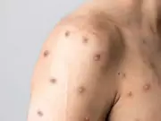 Sesap confirma 3 novos casos de mpox no RN; total chega a 12 em 2026