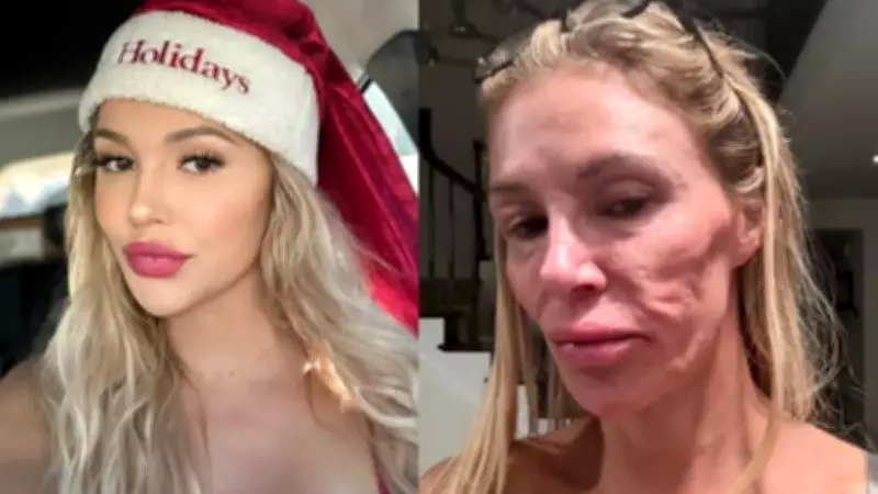 Brandi Glanville culpa parasita sexualmente transmissível por deformação facial