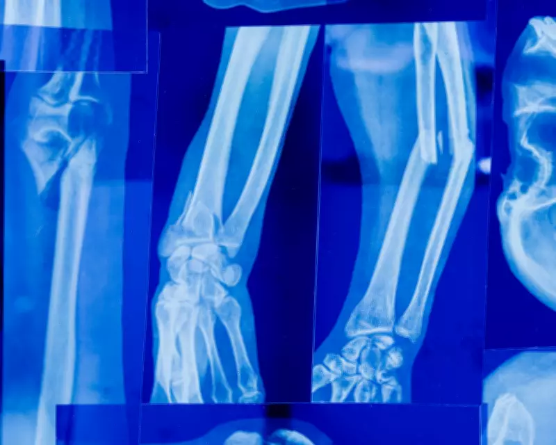 Osteopenia: condição silenciosa afeta 40% dos adultos no mundo