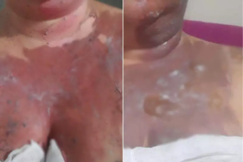Prefeitura de Praia Grande é condenada a indenizar merendeira queimada por panela de pressão