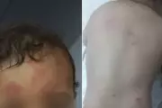 Bebê de 1 ano sofre mordidas e hematomas em creche de Guarujá; mãe denuncia negligência