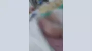 Bebê de três meses recebe alta após objeto esquecido no pulmão em SE