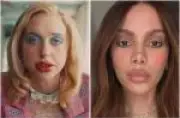 De Anitta a Chloe Cherry: especialistas alertam sobre excesso de preenchimento labial