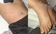 Menina internada com suspeita de contaminação por detergente tem infecção viral