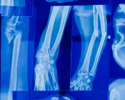 Osteopenia: condição silenciosa afeta 40% dos adultos no mundo