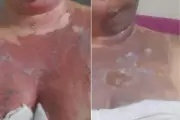 Prefeitura de Praia Grande é condenada a indenizar merendeira queimada por panela de pressão