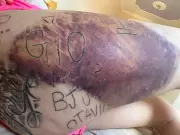 Vítima de tortura em Itapetininga inicia remoção de tatuagens feitas à força pelo ex