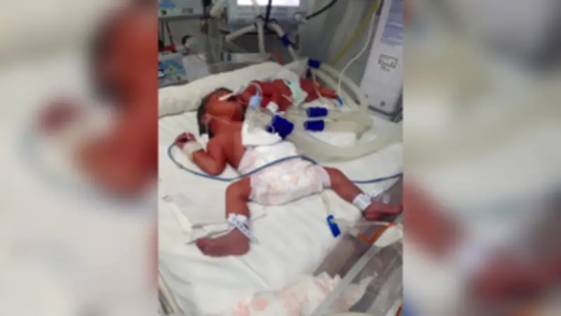 Adiada quinta cirurgia de separação das gêmeas siamesas Heloísa e Helena