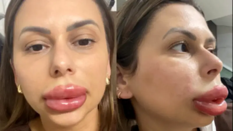 Confeiteira viraliza com reação alérgica a preenchimento labial