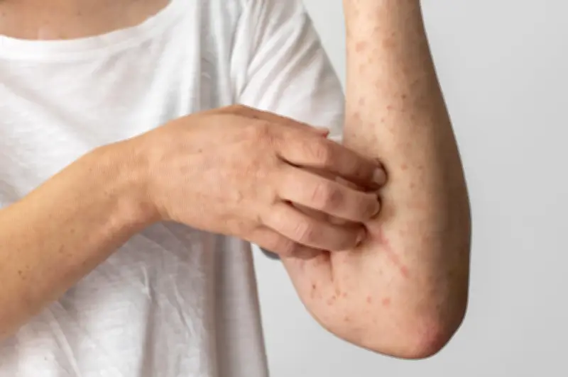 Estudo revela que coçar picada de inseto piora inflamação