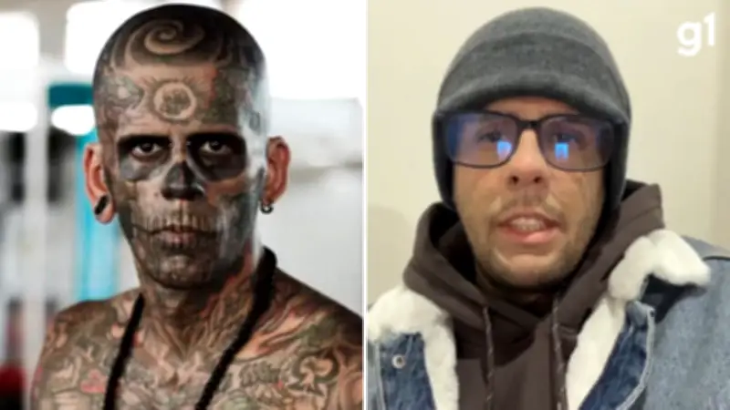 Homem mais tatuado do Brasil segue com remoção facial mesmo com insuficiência renal