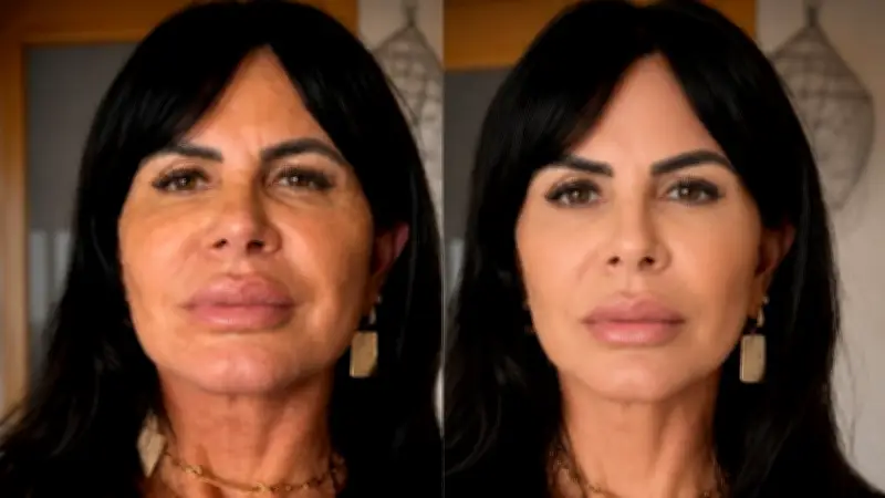IA simula rosto com menos volume e auxilia na reversão de preenchimentos faciais