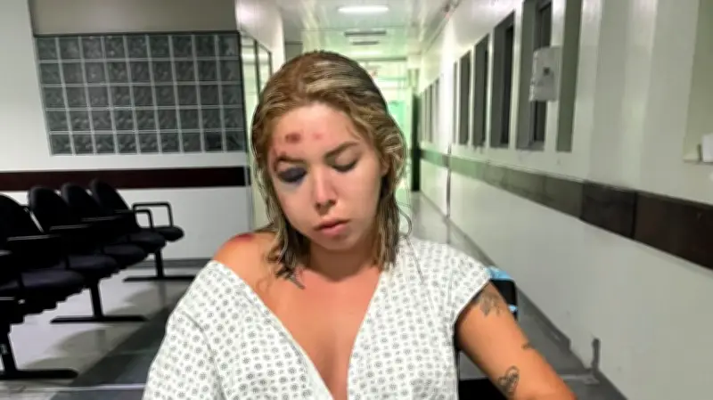 Jovem fratura rosto após ser atropelada por motorista de app em Florianópolis
