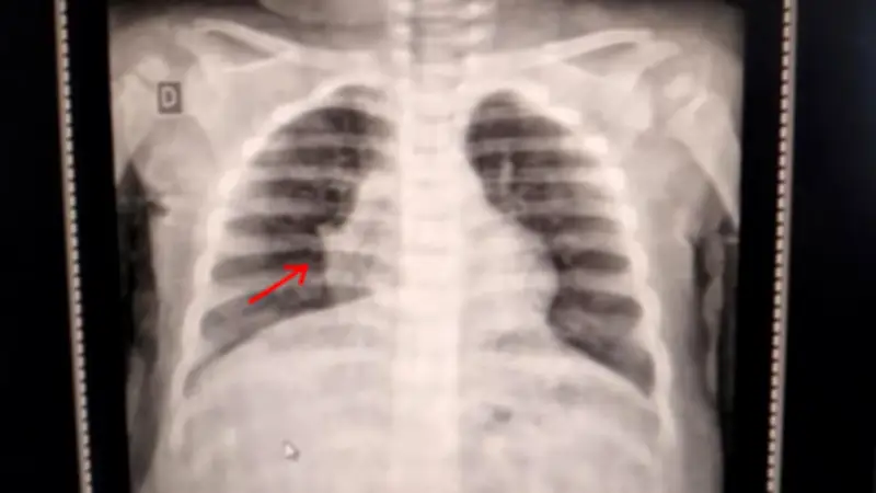 Justiça determina internação de bebê com pneumonia em até 24h em Araçatuba