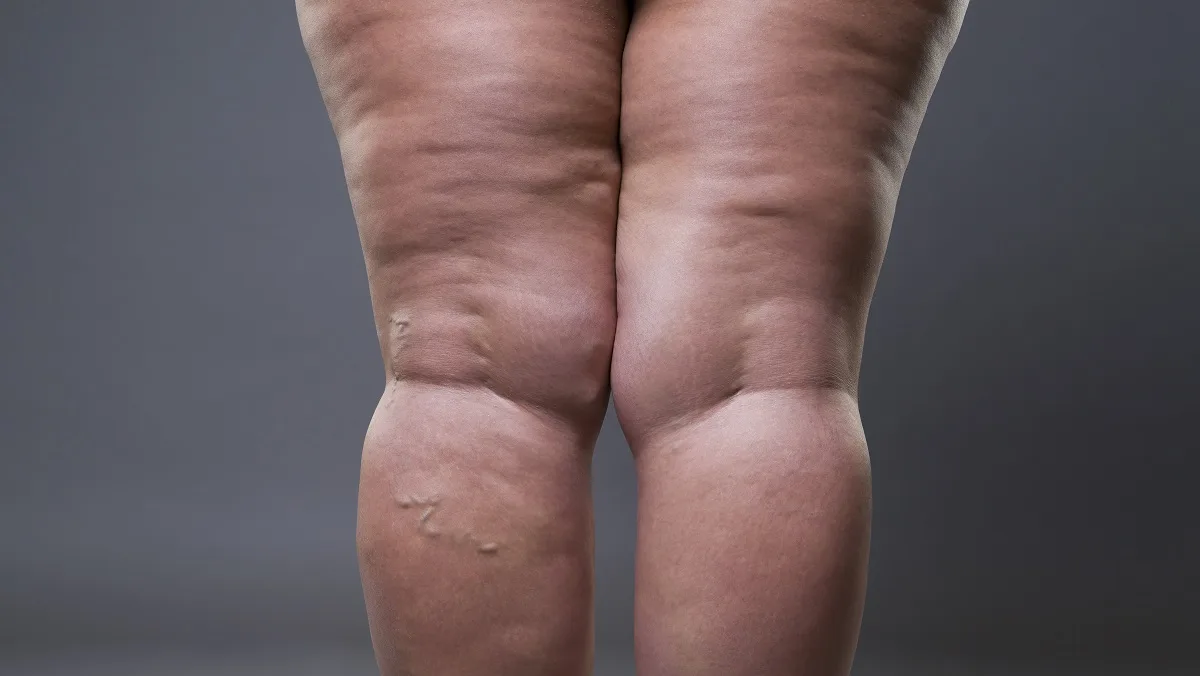 Lipedema: doença vascular crônica afeta principalmente mulheres