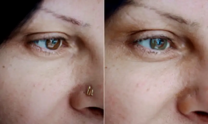 Médico francês cria técnica para mudar cor dos olhos; entenda riscos