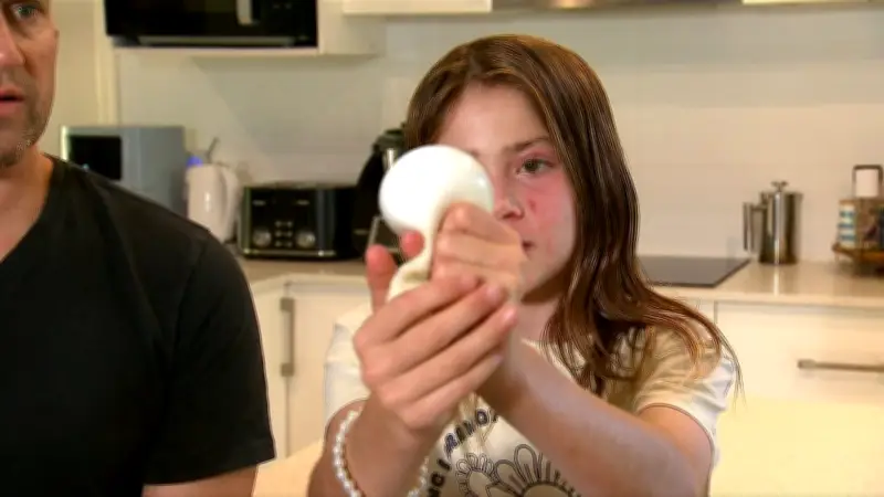Menina de 10 anos sofre queimaduras no rosto ao fazer desafio com brinquedo squishy