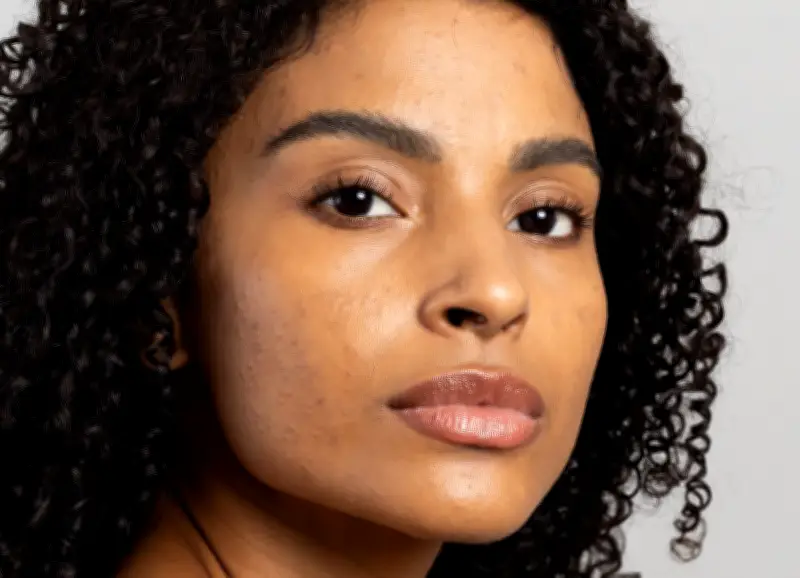 Mês de Conscientização da Acne Incentiva Cuidados Especiais com a Pele