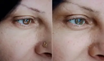 Médico francês cria técnica para mudar cor dos olhos; entenda riscos
