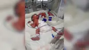 Adiada quinta cirurgia de separação das gêmeas siamesas Heloísa e Helena