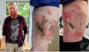 Bateria de vape explode no bolso e provoca queimaduras graves