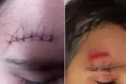 Criança de 6 anos leva seis pontos após ser empurrada em escola