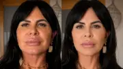 IA simula rosto com menos volume e auxilia na reversão de preenchimentos faciais